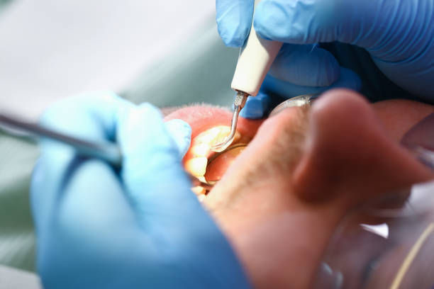 Best Emergency Root Canal Treatment in Azle, TX